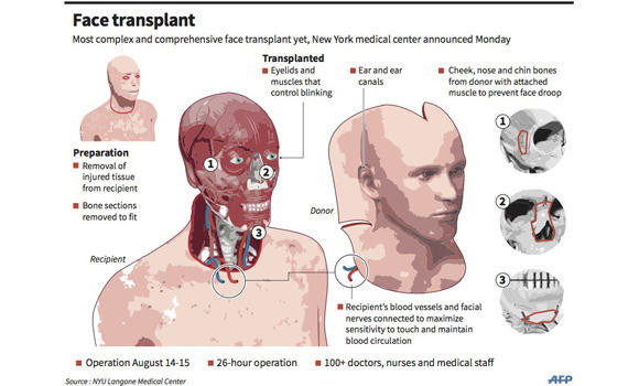 Saving face: transplanting our most distinctive features